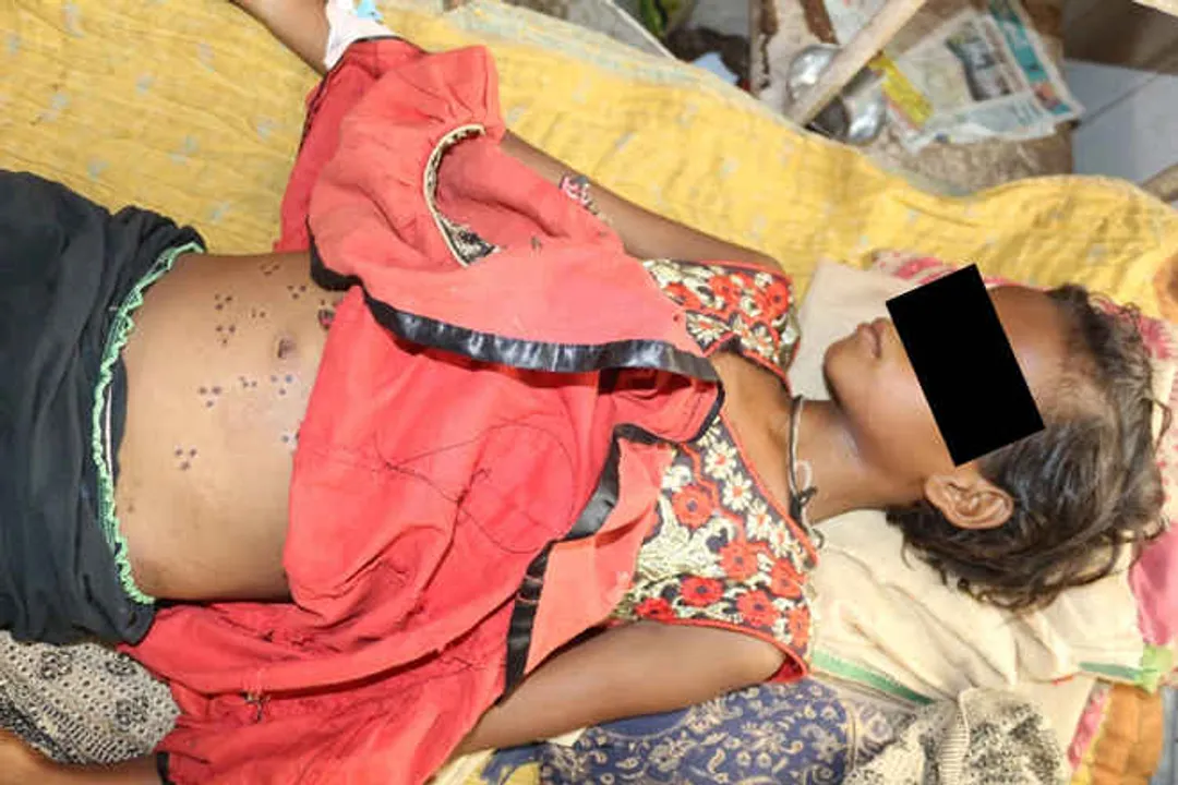  Barbaric act continues in Odisha, 10-yr girl branded with hot iron rod