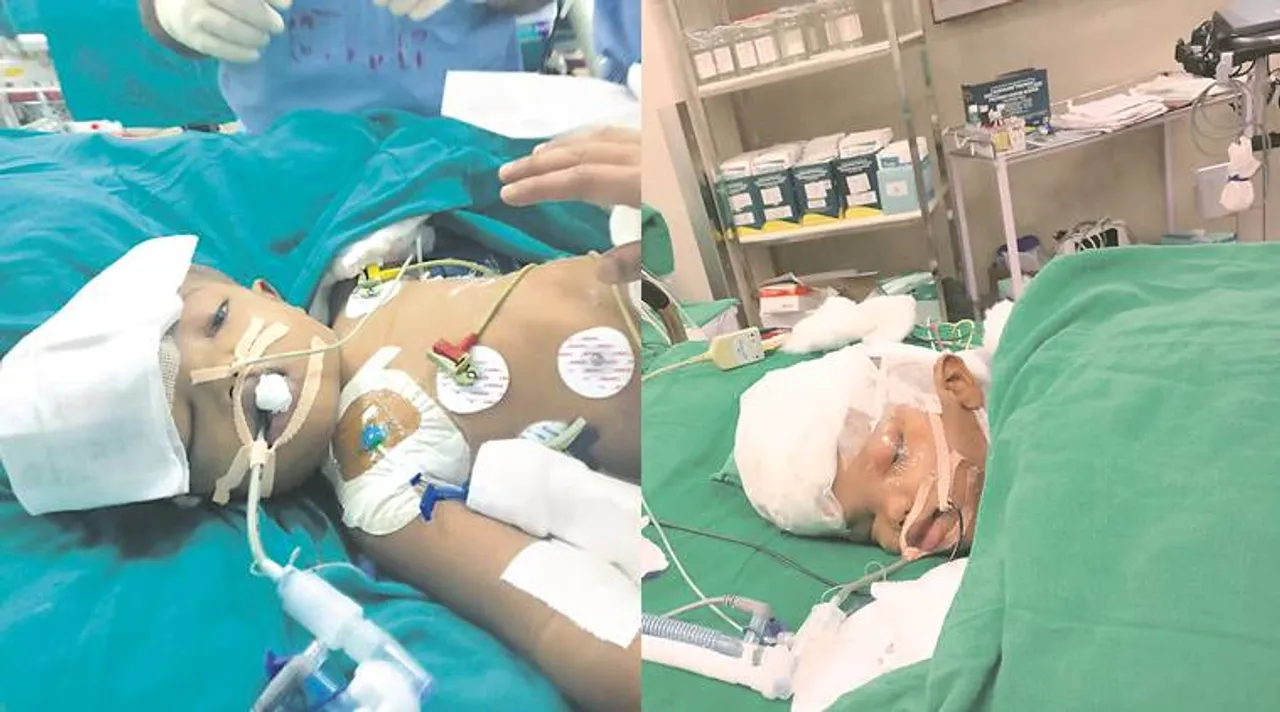  Odisha's separated conjoined twins Jaga to return home soon!