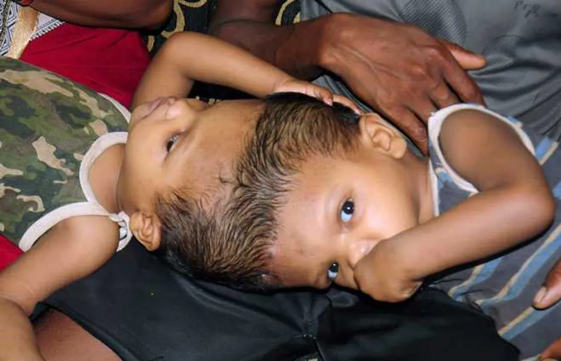  Condition of Odisha's one of conjoined twins Jaga unwell