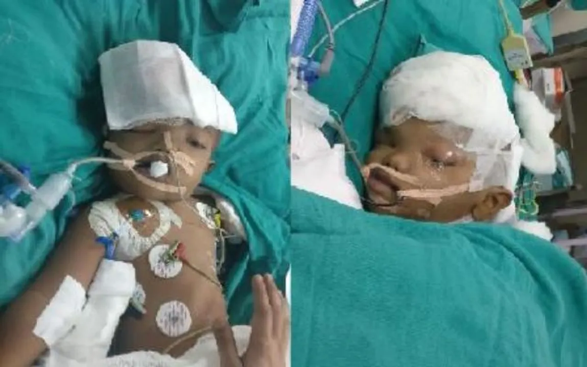  Separated conjoined twins from Odisha to take 8-9 months to get discharged