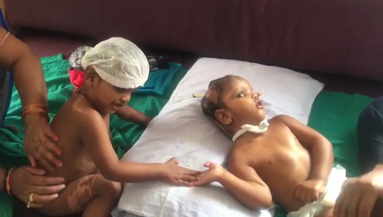  Watch Odisha's separated conjoined twins Jaga-Kalia playing at AIIMS