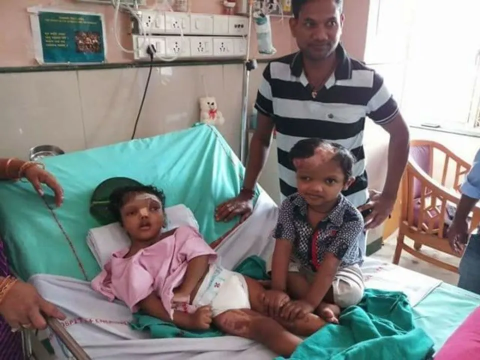  Separated conjoined twins Jaga-Kalia not to return to Odisha soon. Know why