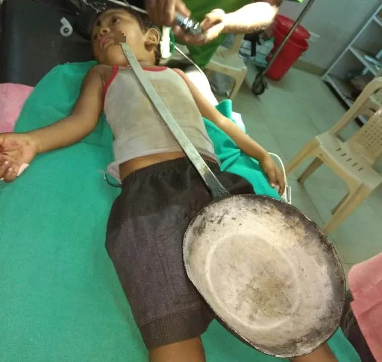  Odisha: Frying pan gets stuck in mouth of 3-year-old boy