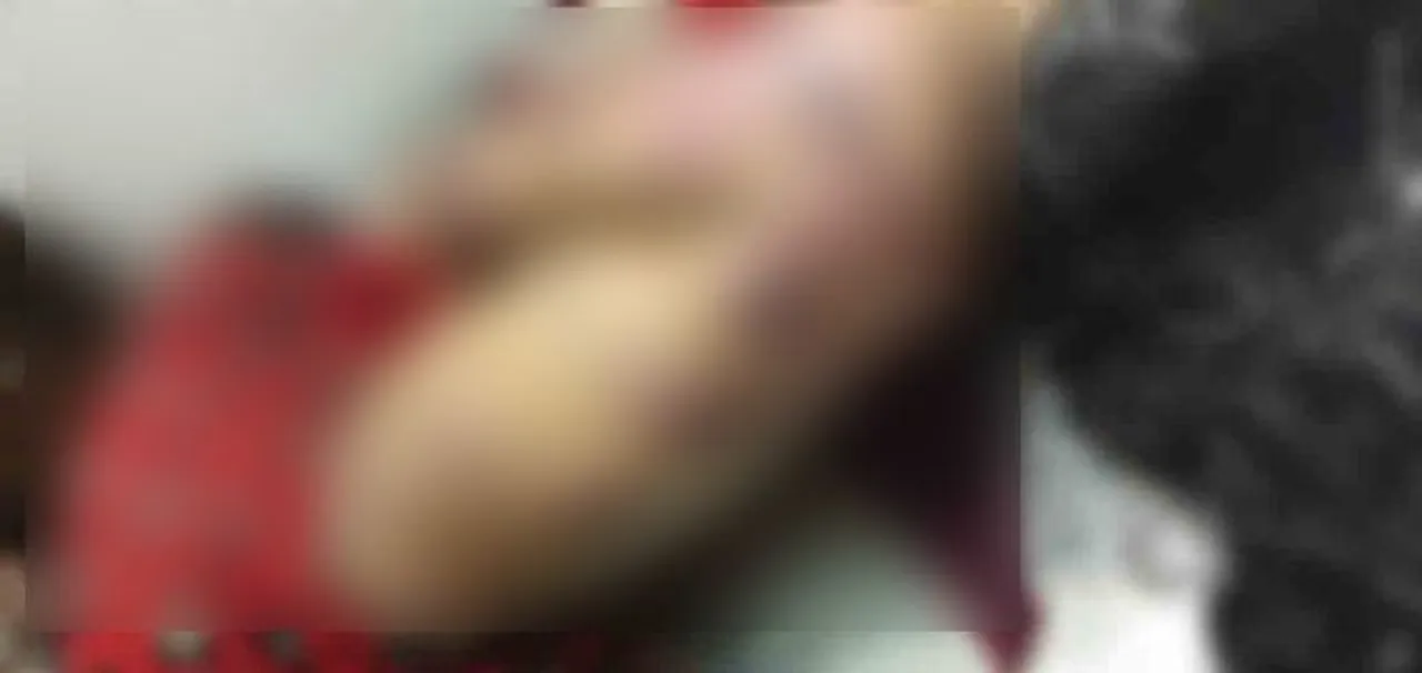  Domestic violence: Odisha woman assaulted by hubby, branded with iron rod