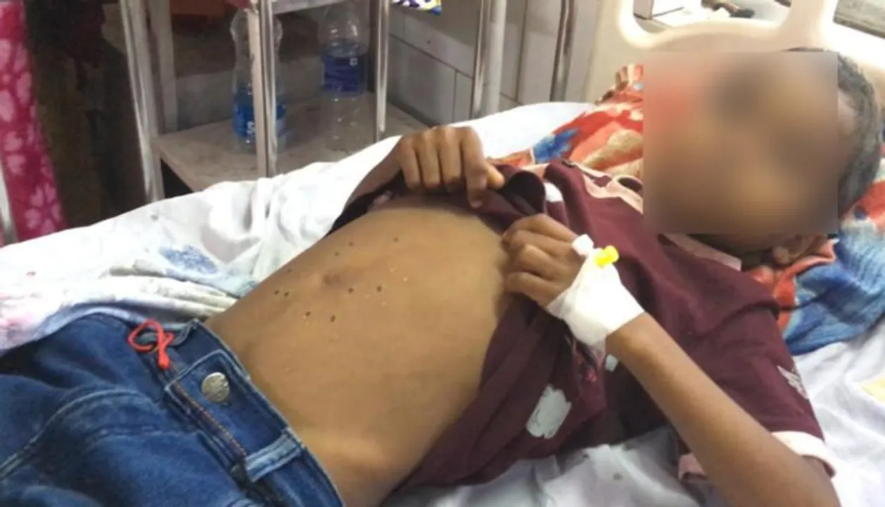  7-year-old boy branded with hot iron in Odisha’s Sundergarh  