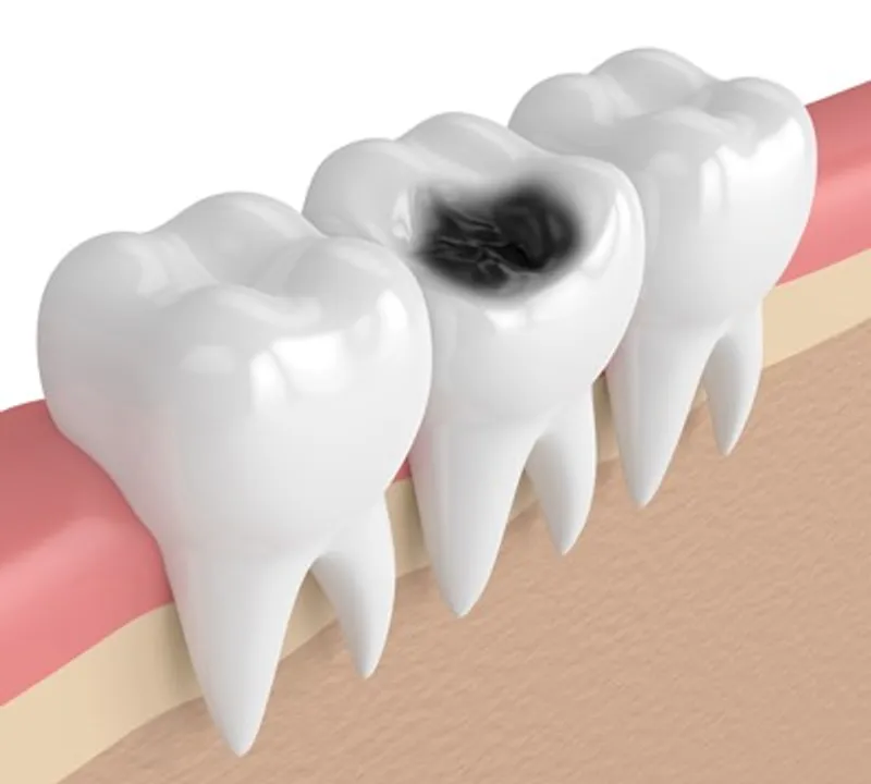  Whitening products may cause tooth decay
