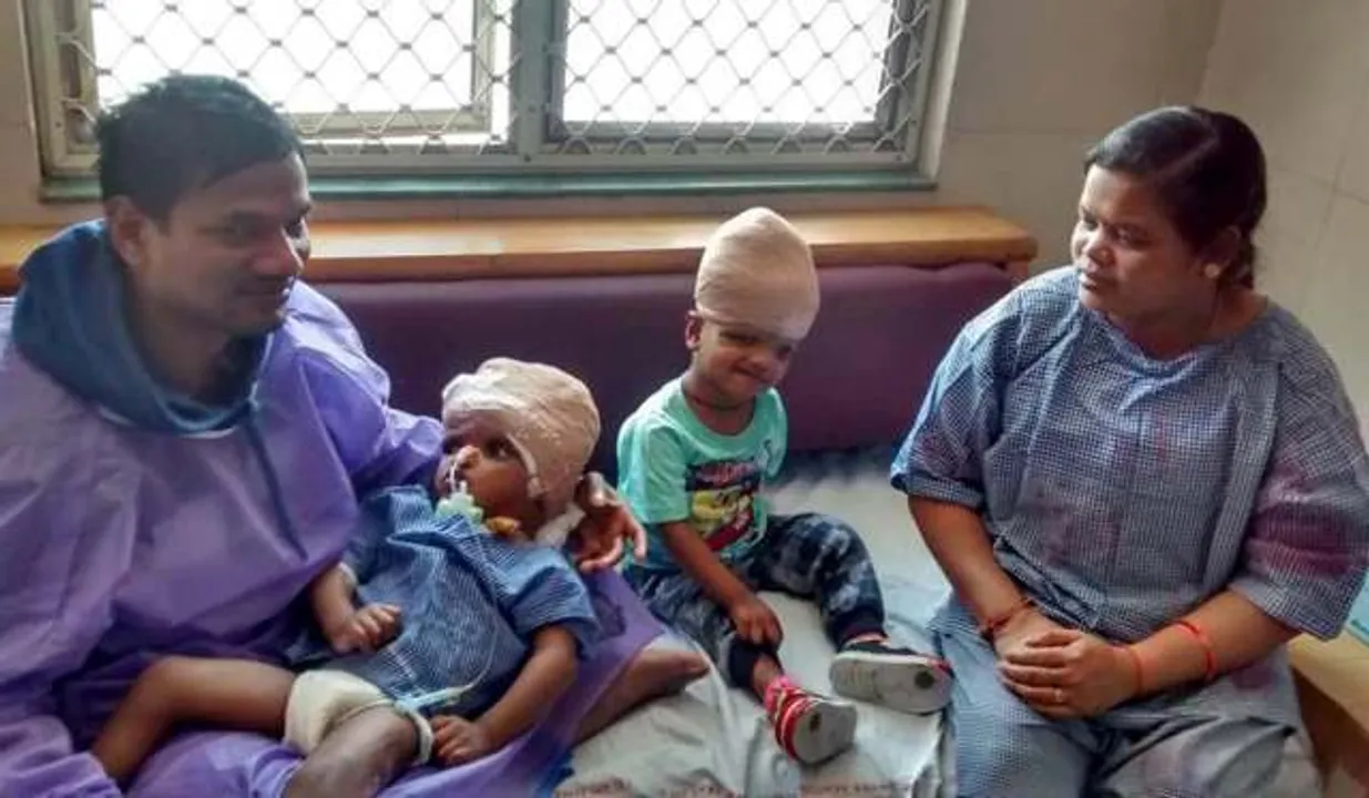  Separated conjoined twins Jaga, Kalia to return to Odisha soon