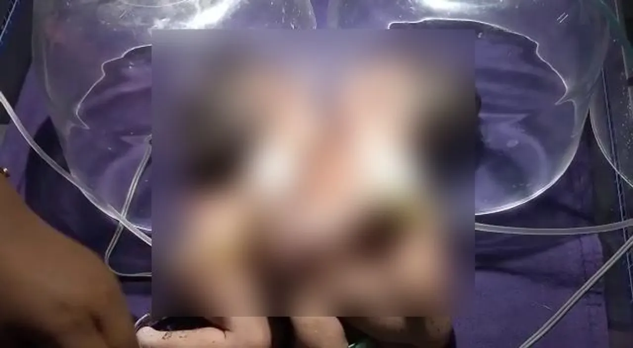  After Jaga-Kalia, another conjoined twins born in Odisha