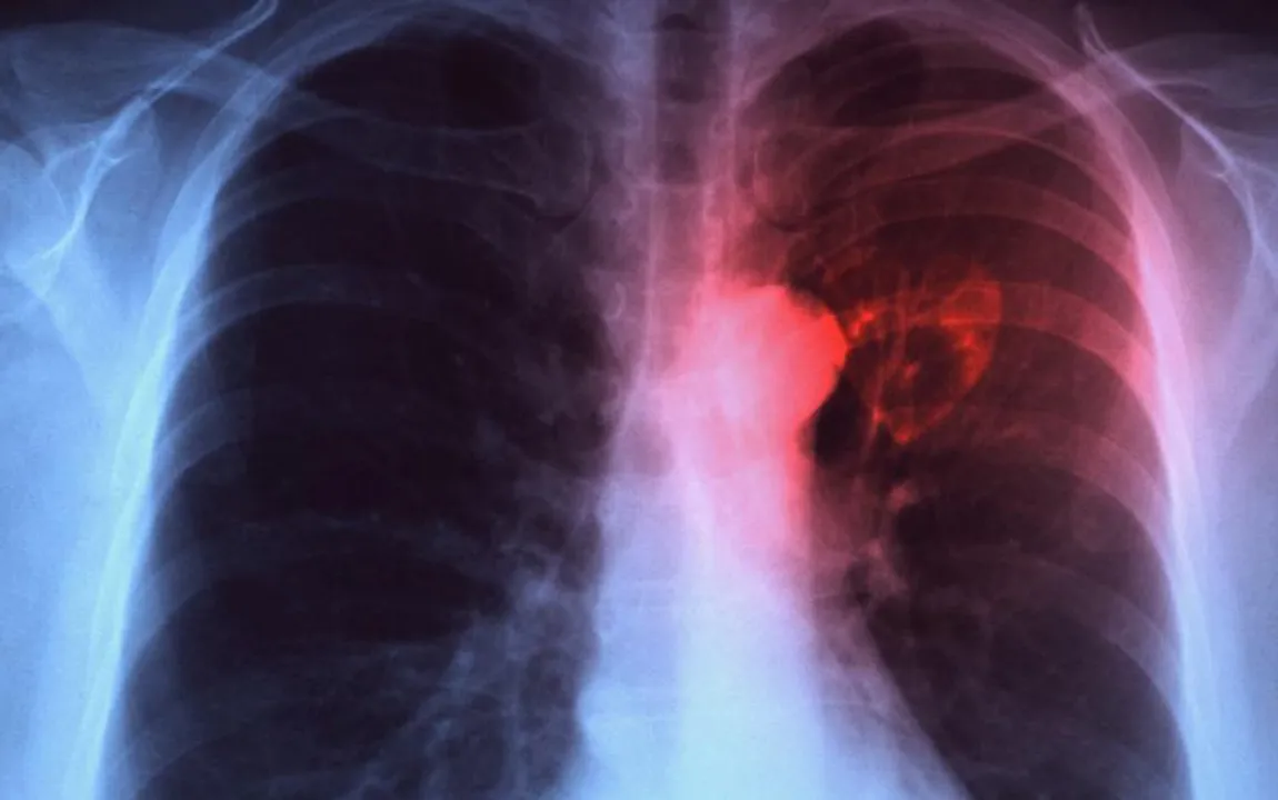  21.5 lakh TB cases reported in 2018 in India