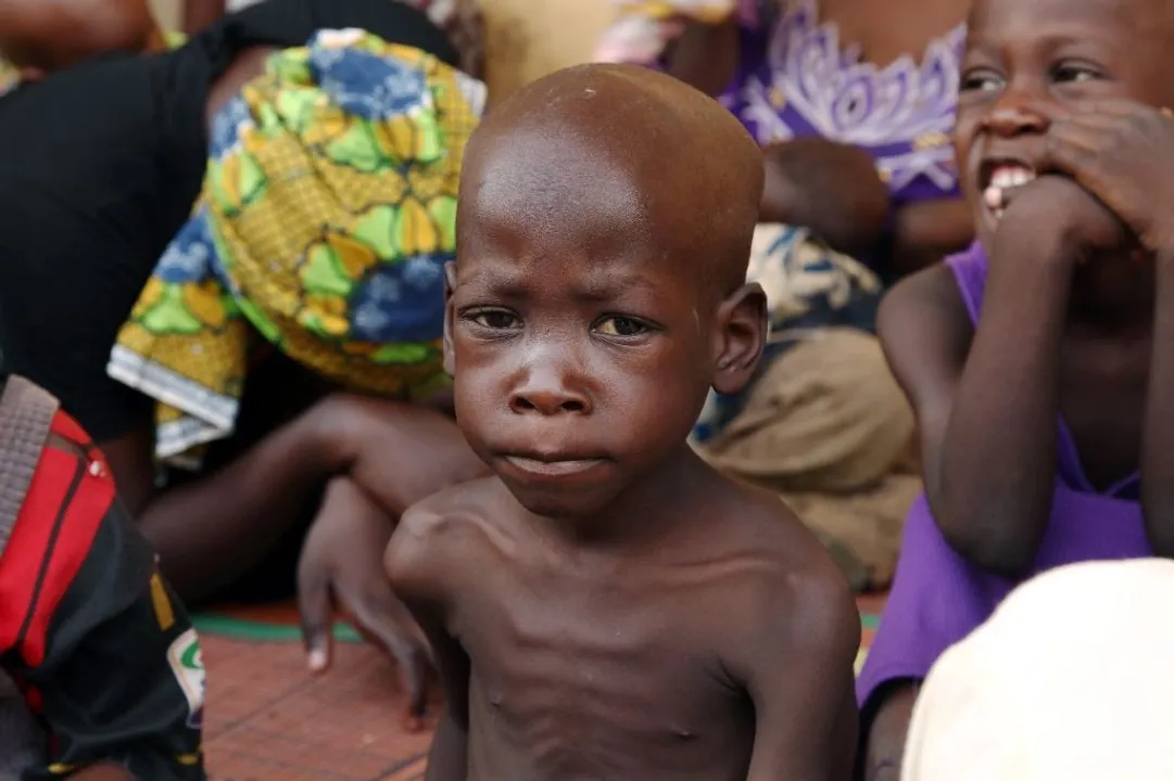  1 in 3 children under 5 malnourished: UNICEF report