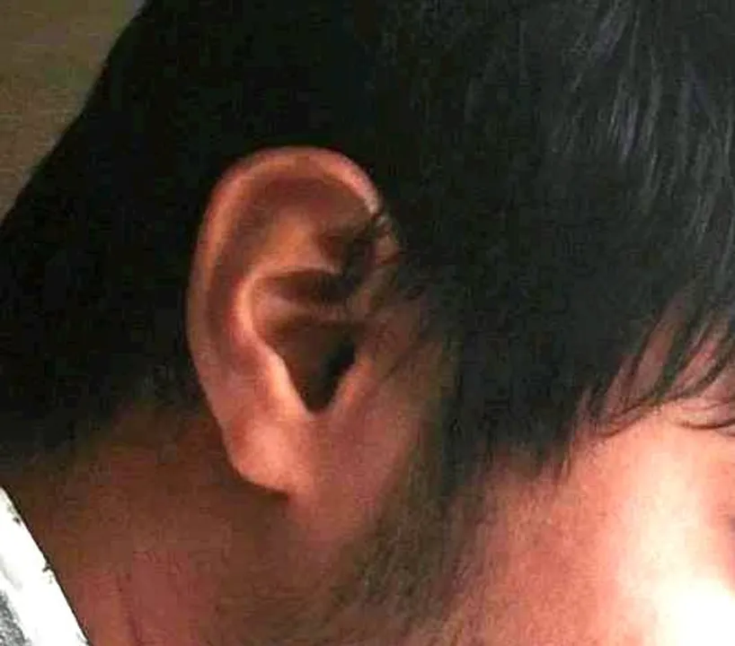  Study reveals how opioid use can trigger deafness