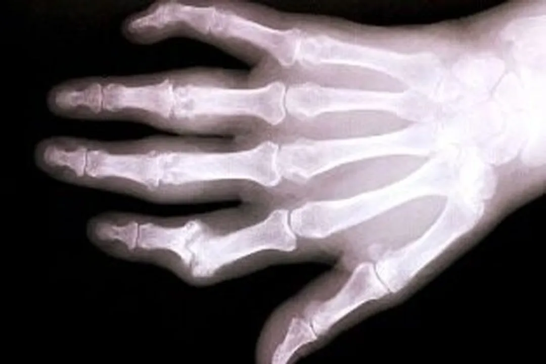  Osteoporosis treatment may also protect against pneumonia