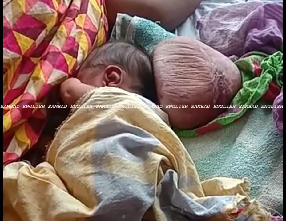  Baby born with two heads in Odisha hospital