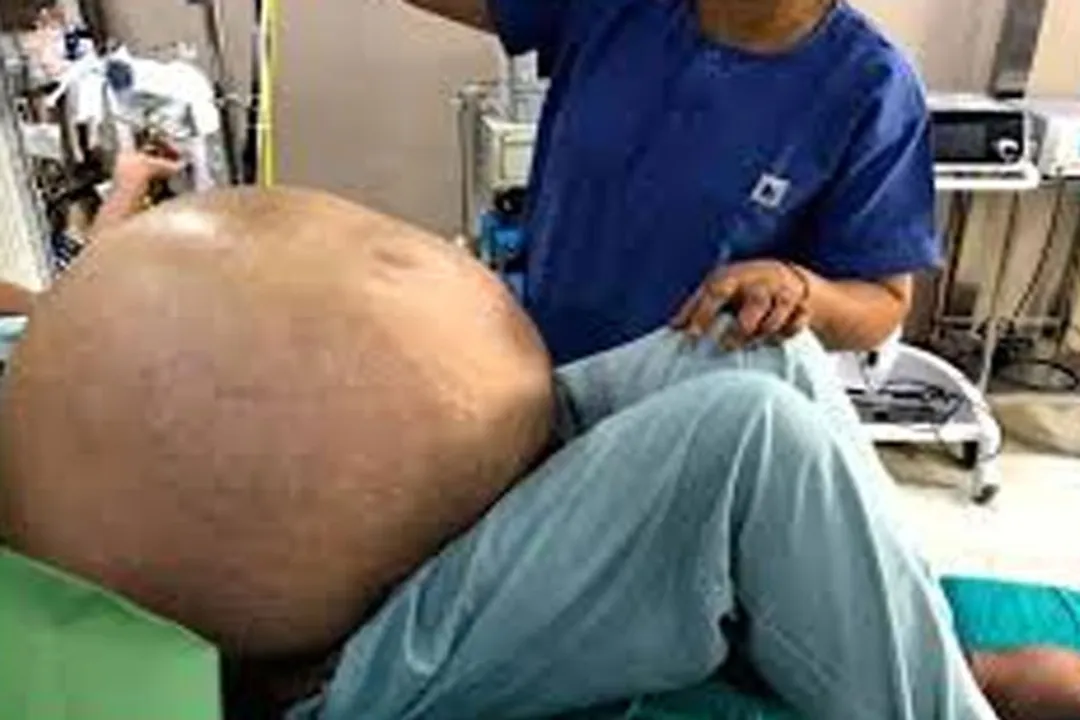  50 kg ovarian tumour removed from woman