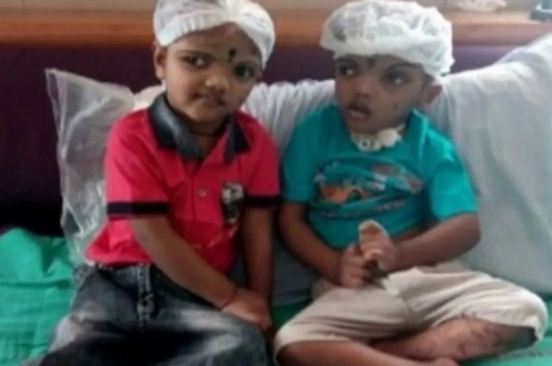  Balia, one of separated conjoined twins from Odisha, dies