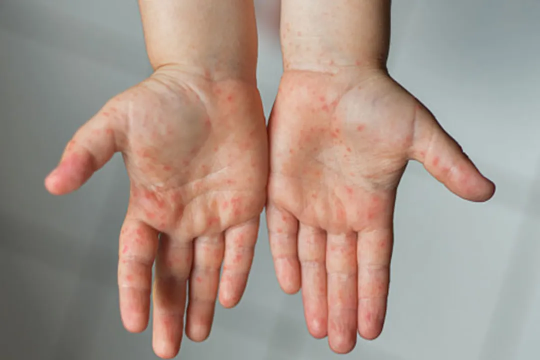  Major measles outbreaks forecast for 2021 due to Covid: Study