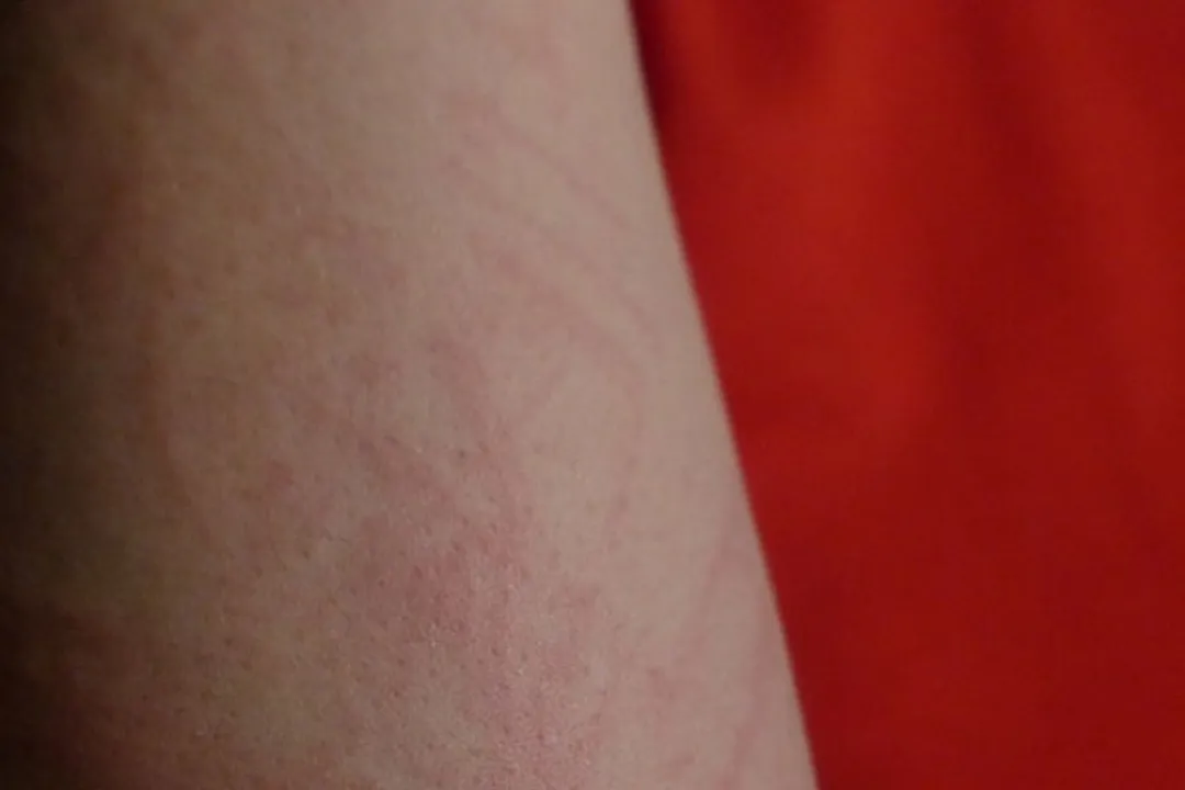  Study links skin rashes to Covid