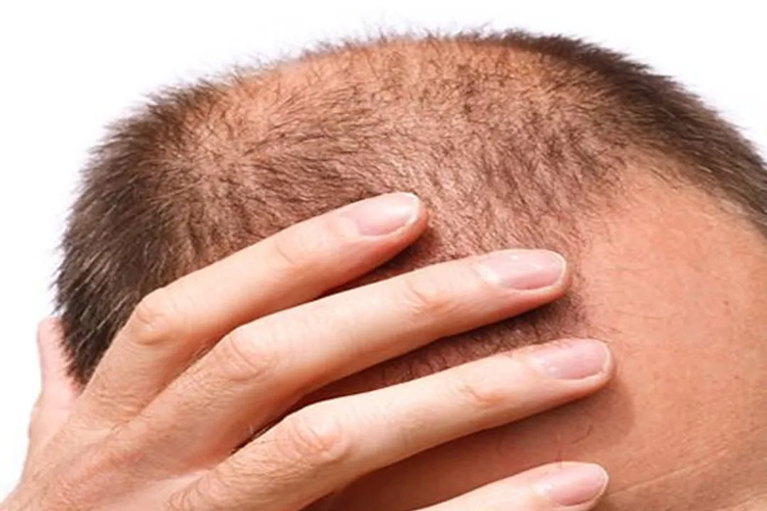  Gene linked to balding may up Covid severity in men