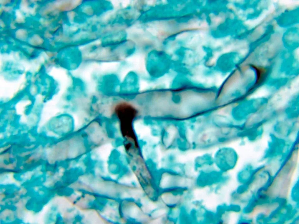  What is Black Fungus or Mucormycosis; how it is linked to Covid-19