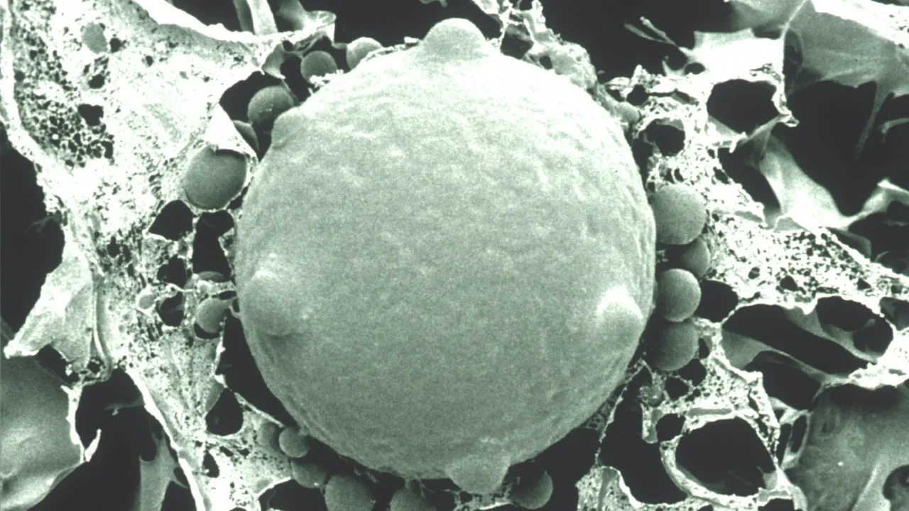  How rare 'White Fungus' affected a recovered coronavirus patient's gut; read details
