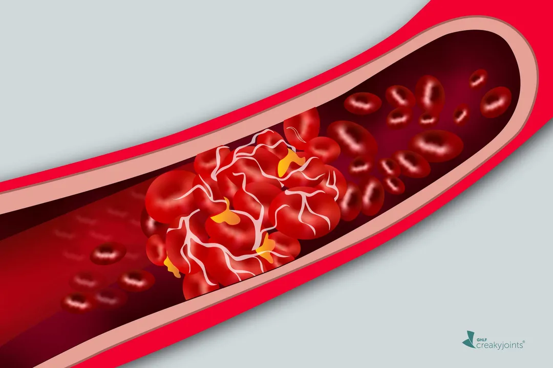  Autoantibody found in Covid-19 patients sparks 'firestorm' of blood clots, inflammation