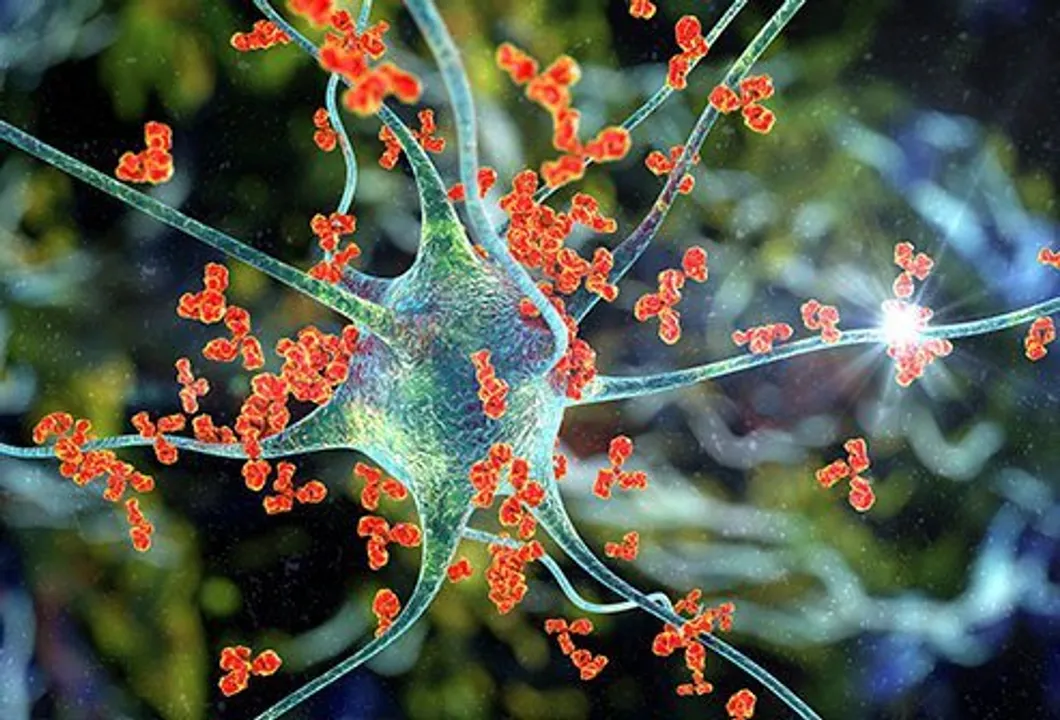  Covid-19 can trigger auto-immune disorder called Guillain-Barre syndrome: Study