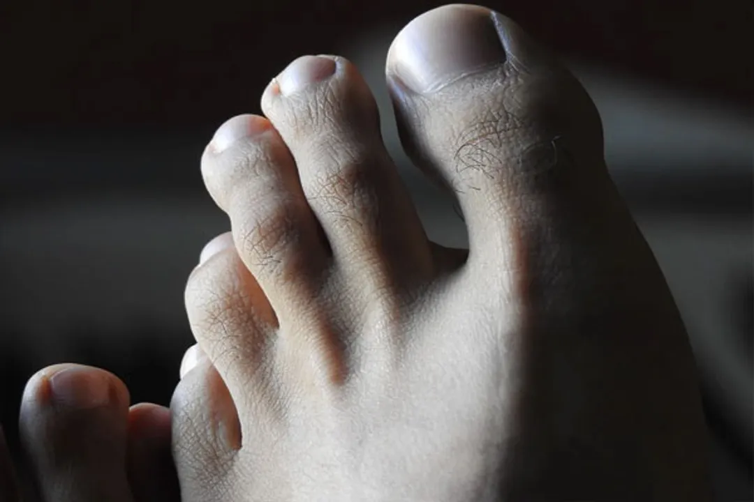  Know what causes Covid toe condition