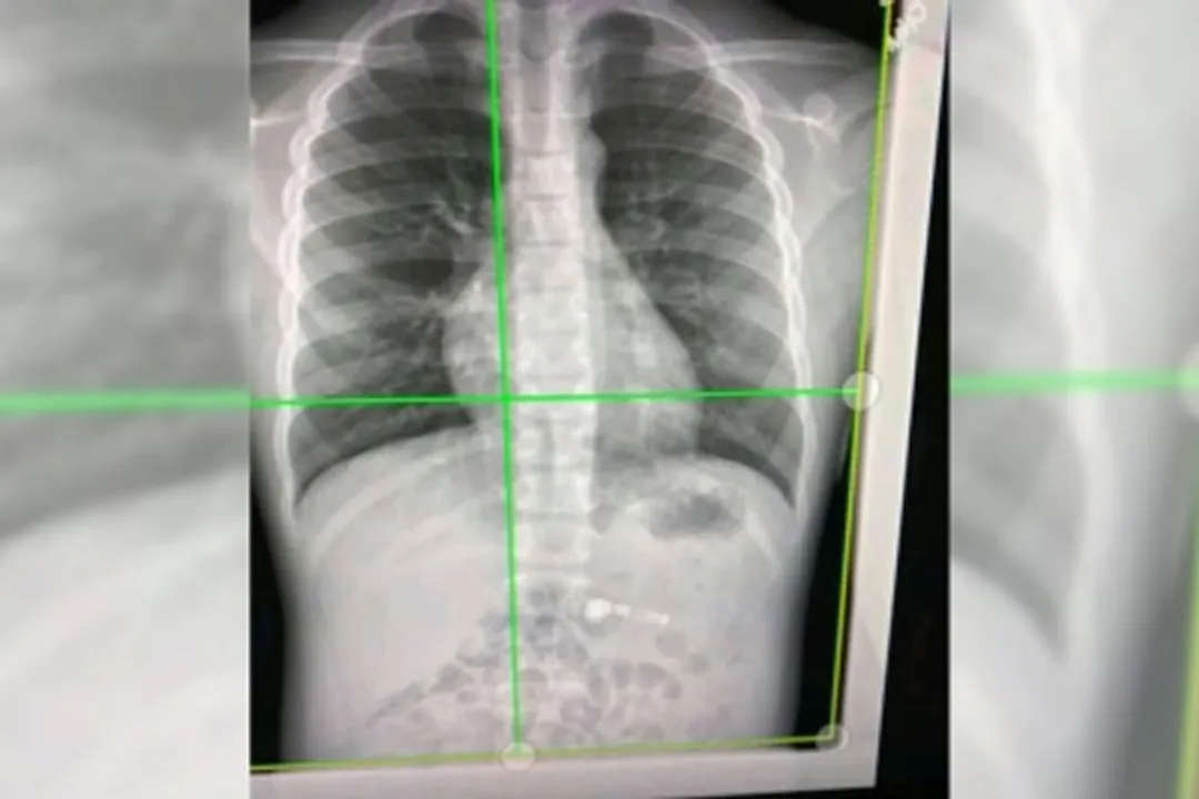  Lung vessels altered by Covid-19, show high-energy X-rays