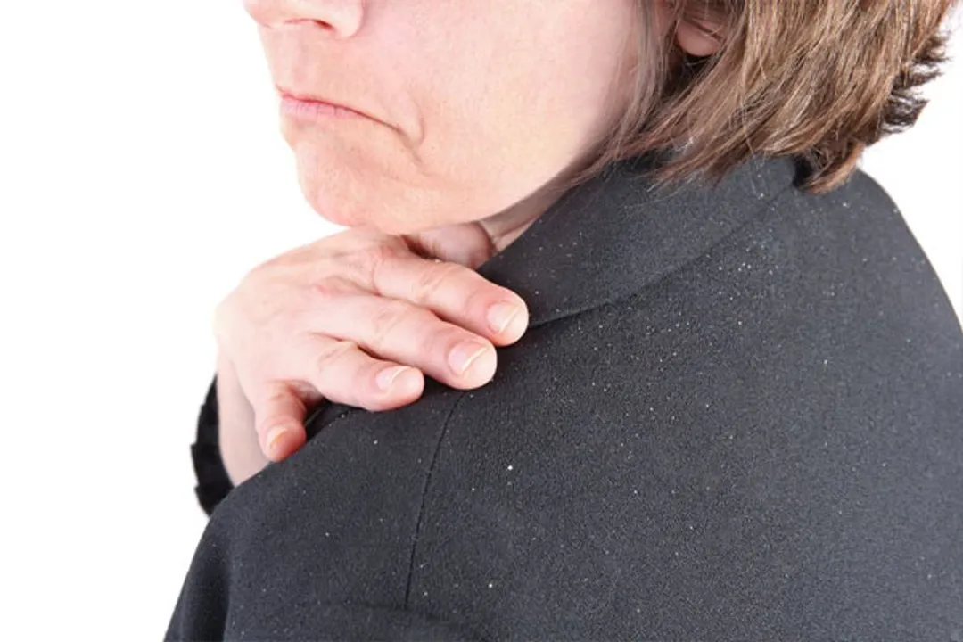  10 Best Ways to get rid of Dandruff in Winter