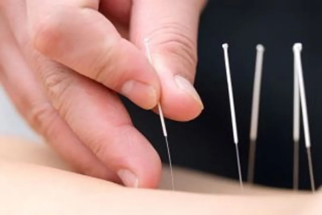  Is Acupuncture key to restoring your body's Thyroid Balance?