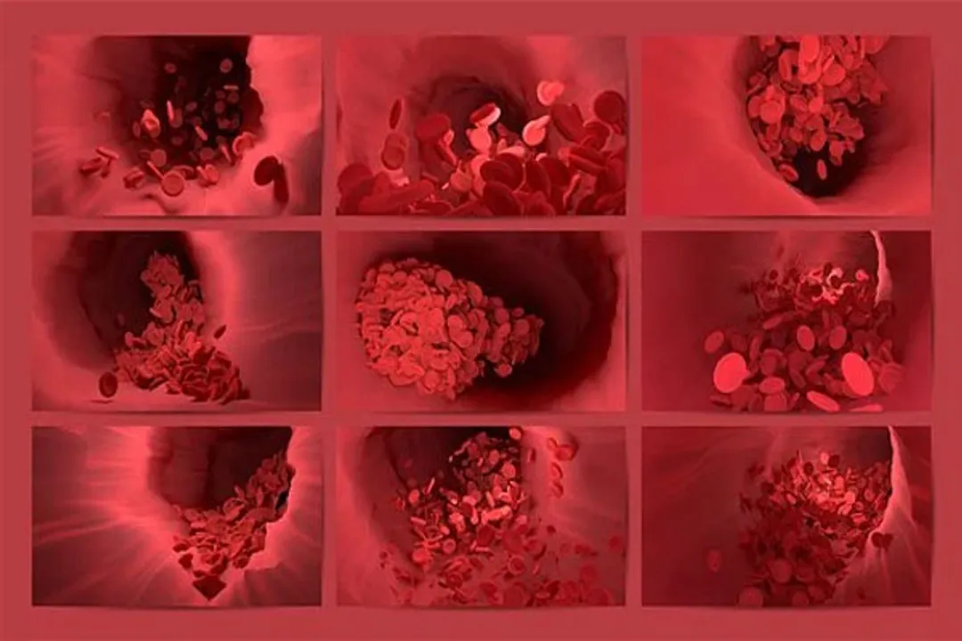  Scientists explain mechanisms associated with severe Covid blood clotting 