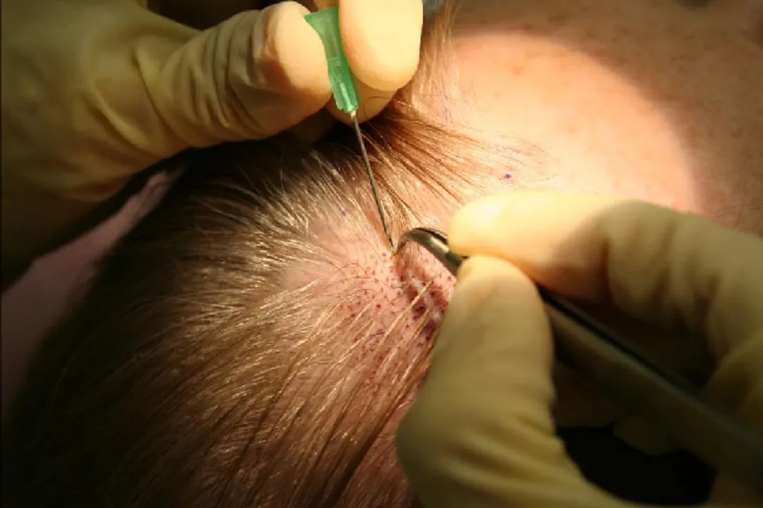  Constable dies a day after hair transplant