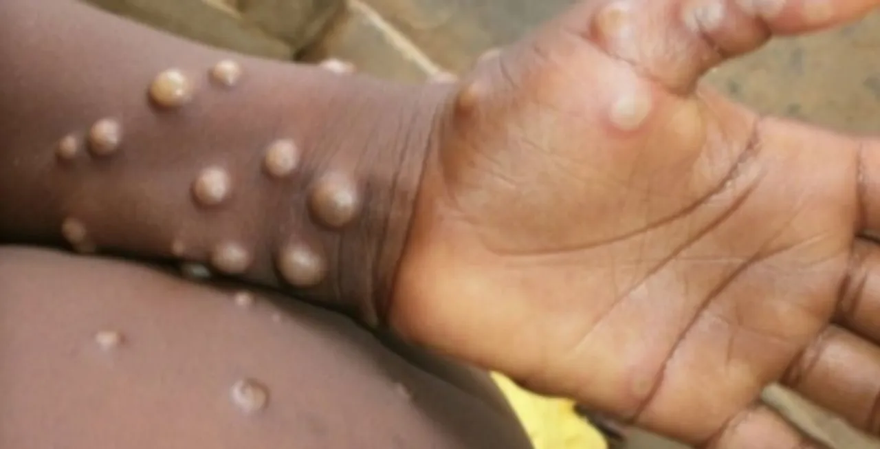  Global cases of monkeypox surpass 1,000