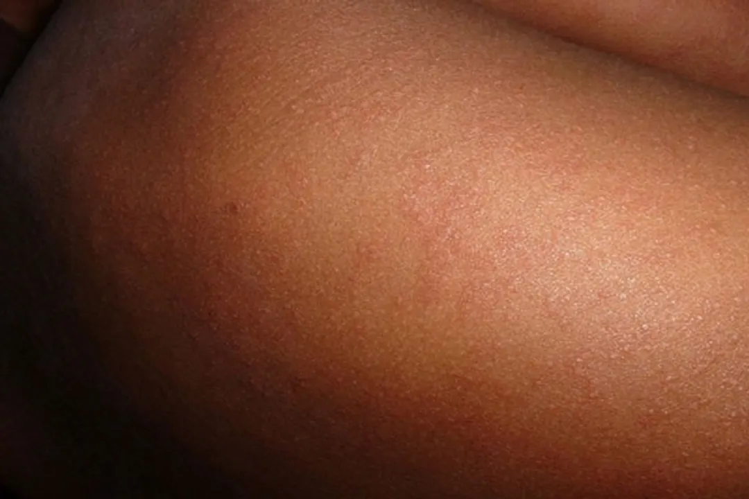  Unicef warns against global measles outbreaks