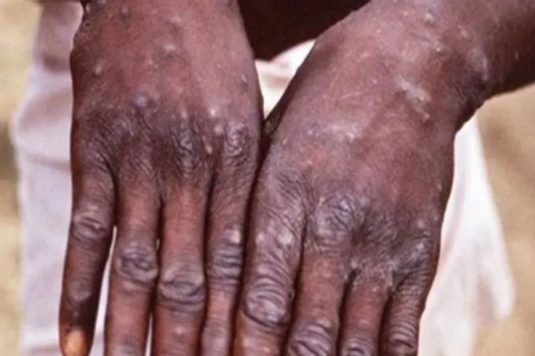  Pakistan declares high alert against monkeypox