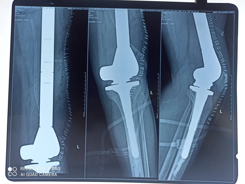  For the first time in Odisha, AIIMS Bhubaneswar conducts total Femur replacement