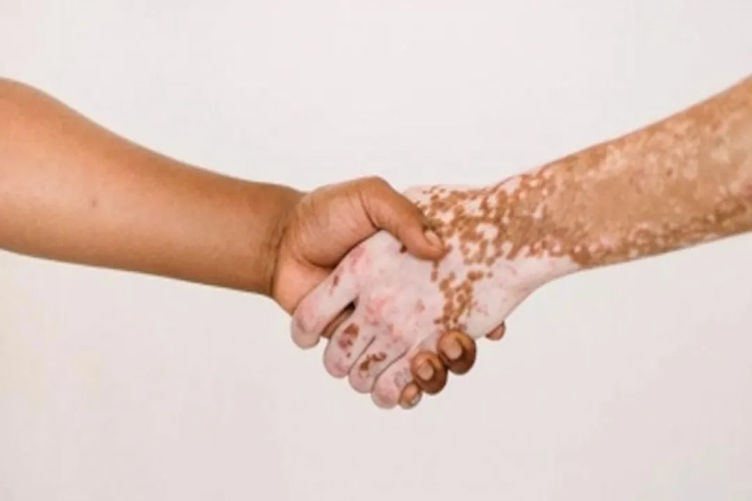  Signs to detect Vitiligo