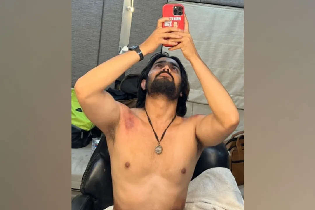  Bhuvan Bam gets injured while shooting for 'Taaza Khabar'