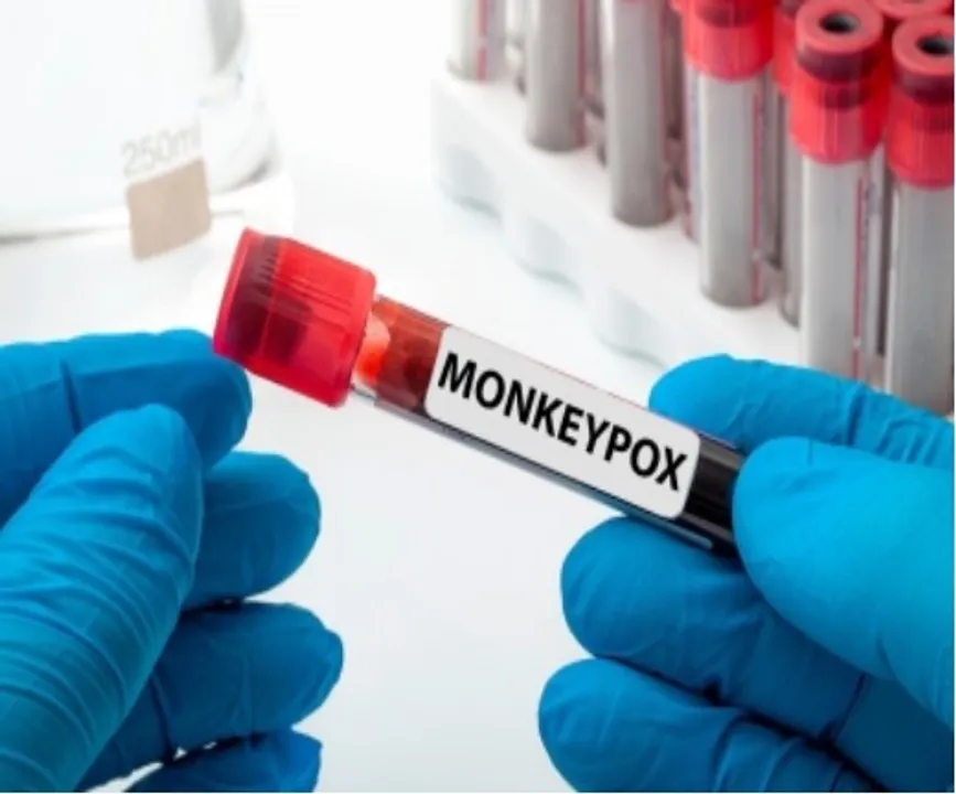  Peru faces 'community transmission' of monkeypox