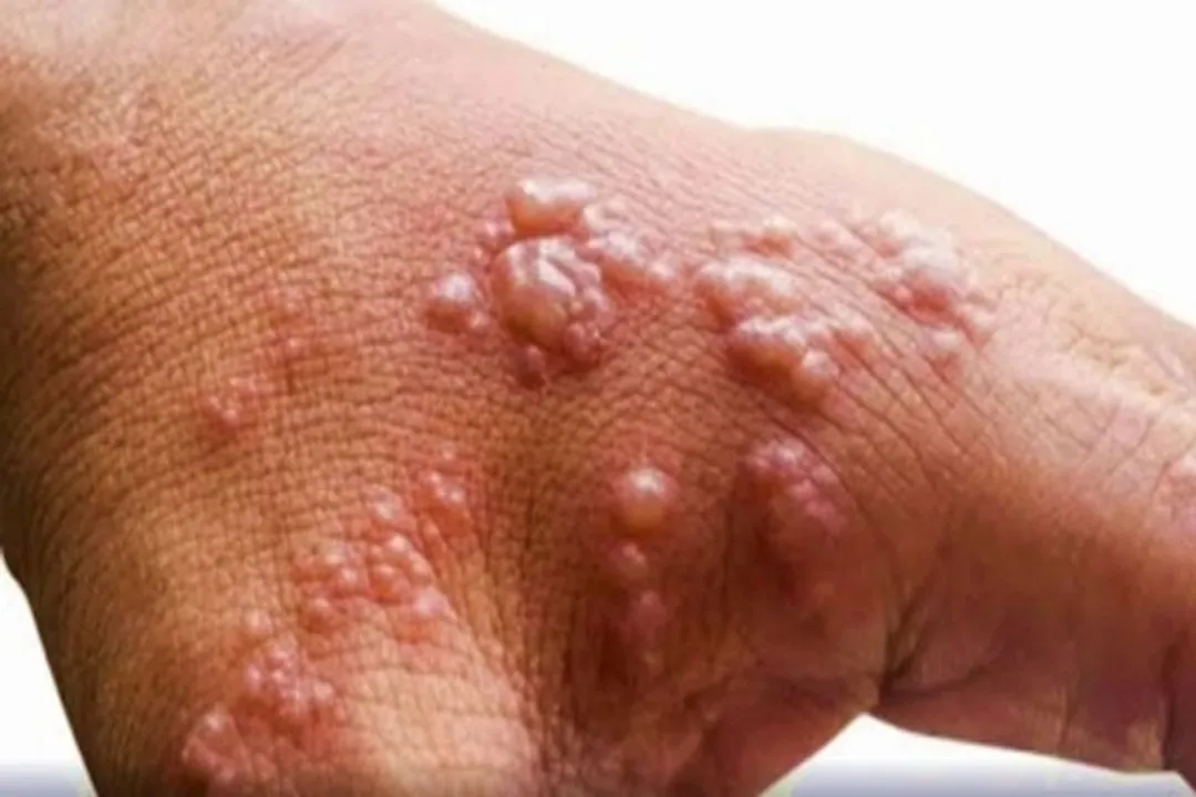  8-YO boy found with suspected Monkeypox symptoms in Andhra