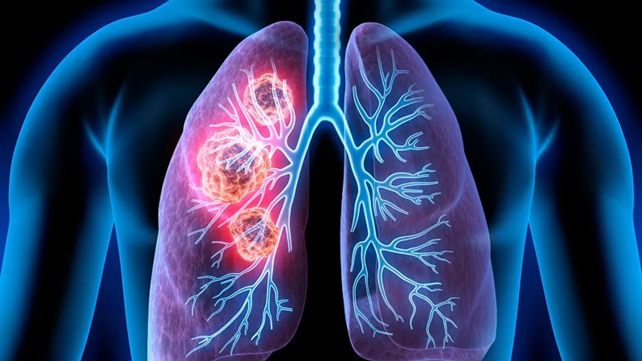  Lung Cancer: Causes, symptoms and treatment options