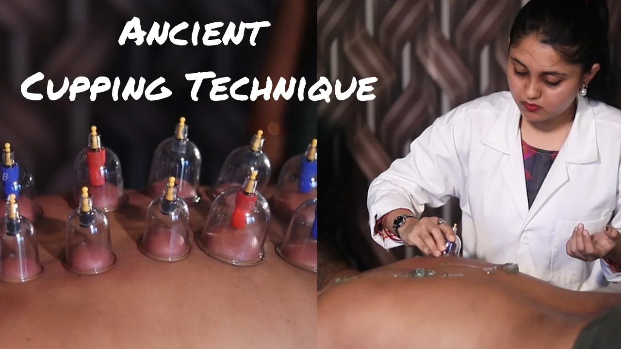  Cupping therapy: Most ancient alternative medication