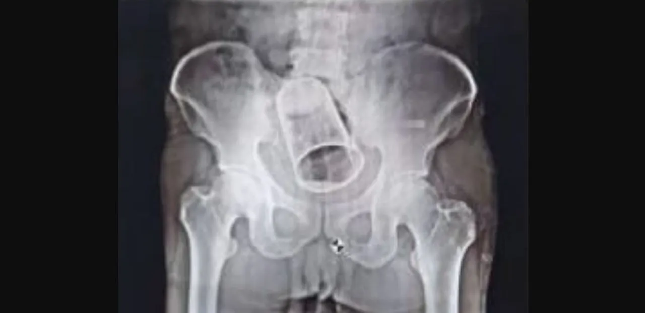  Odisha: Drunk men insert glass inside friend's rectum; Taken out after 8 days
