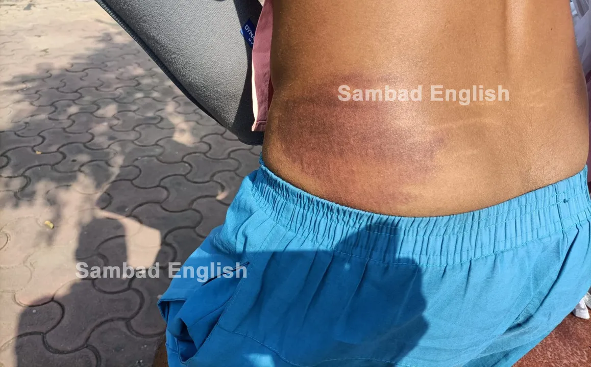  Youth alleges third-degree torture by Hatibari police in Sundargarh