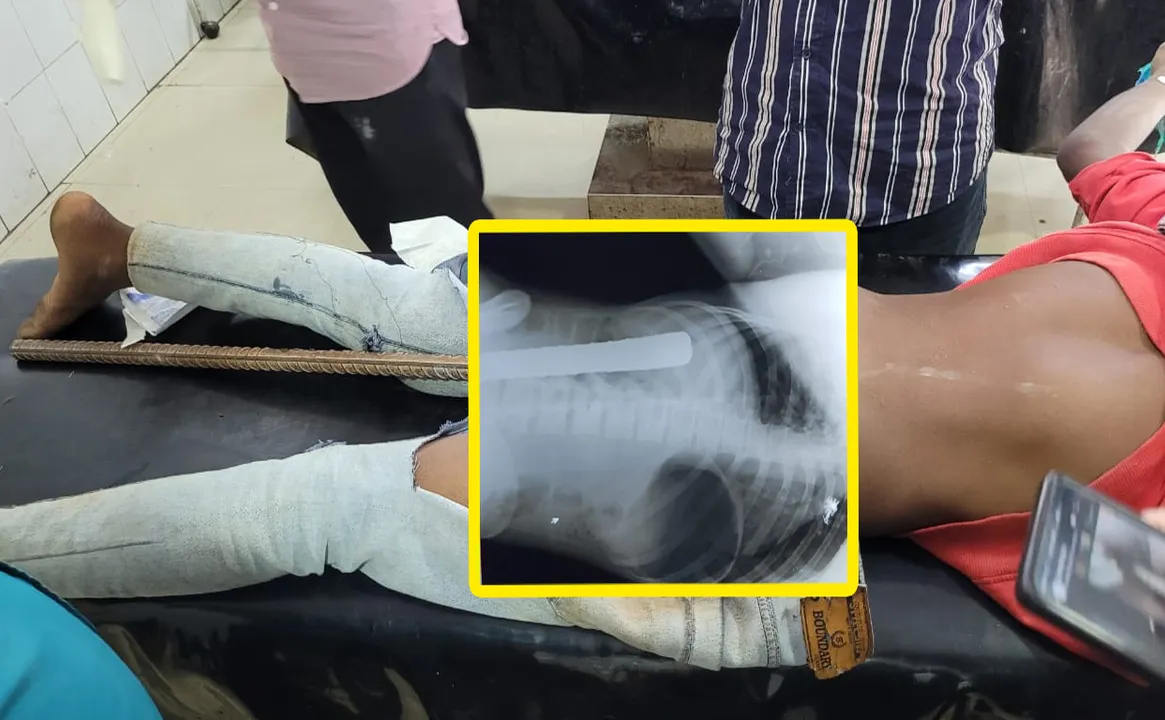  Doctors remove 1.5 ft crowbar from minor's body in Odisha's MKCGMCH
