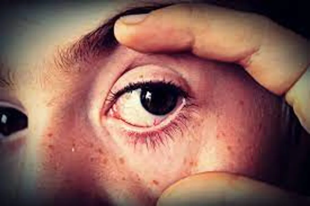  Odisha public health director cautions rise in conjunctivitis cases