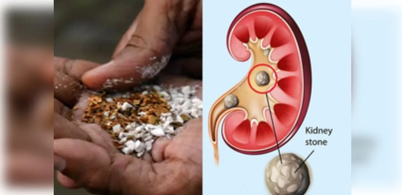  Pan masala consumption can cause larger kidney stones: Experts