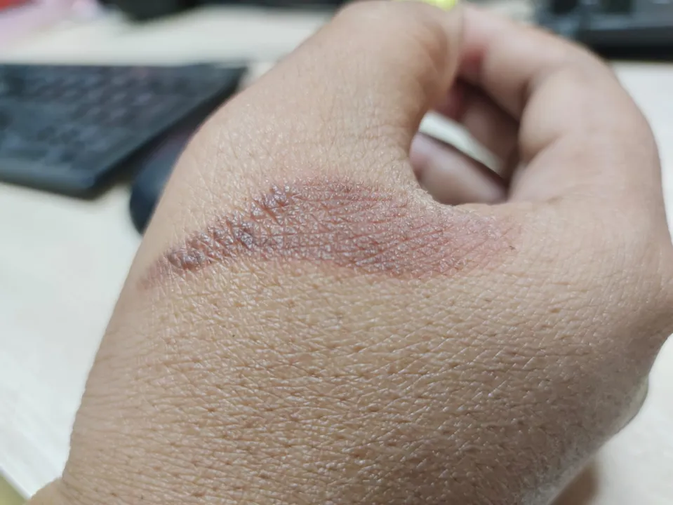  No ice, no toothpaste for burn injuries, say KGMU experts