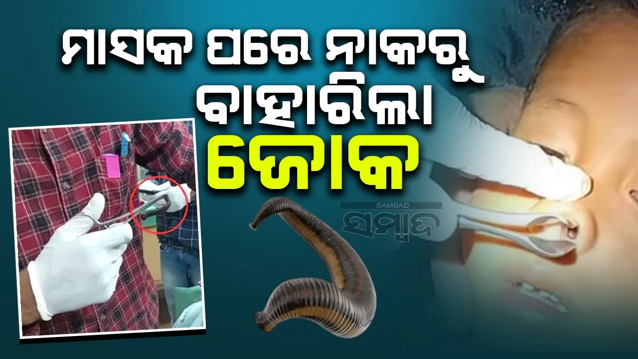  ନାକରୁ ଜୋକକୁ ବାହାର କରି ଶିଶୁର ଜୀବନ ବଞ୍ଚାଇଲେ ଡାକ୍ତର