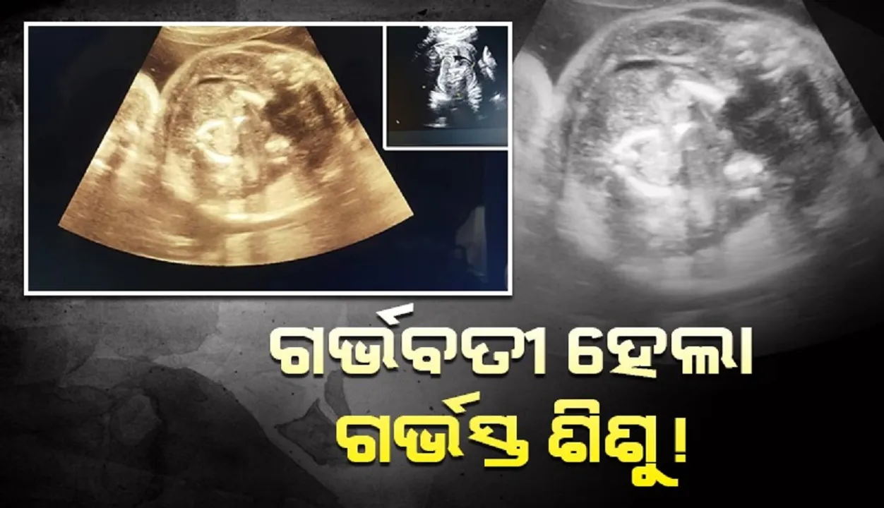  ଗର୍ଭବତୀ ହେଲା ଗର୍ଭସ୍ଥ ଶିଶୁ, ସୋନୋଗ୍ରାଫି ପାଇଁ ପହଞ୍ଚିଥିବା ମହିଳା ହେଲେ ଆଶ୍ଚର୍ଯ୍ୟ !